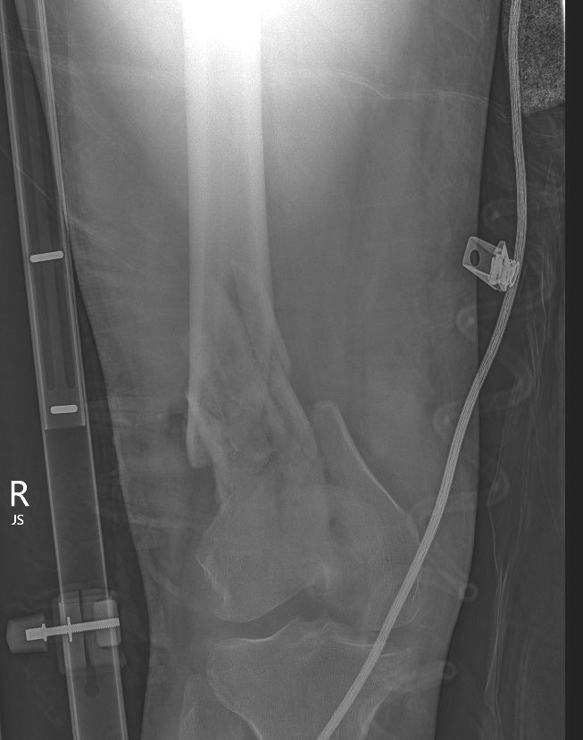 Complex distal femur 2